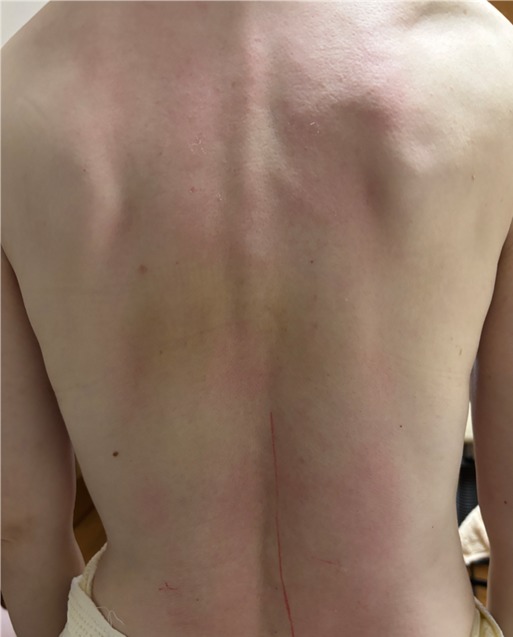 ムクミも取れ。綺麗な出る級の背中になった。背中のラインが美しい。アクア703の特殊技術が大成功。１回施術でほぼ完了！